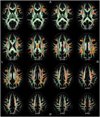 Juvenile Myoclonic Epilepsy Shows Potential Structural White Matter Abnormalities: A TBSS Study